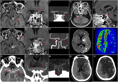 Case Report: Cerebrovascular Events Associated With Bacterial and SARS-CoV-2 Infections in an Adolescent